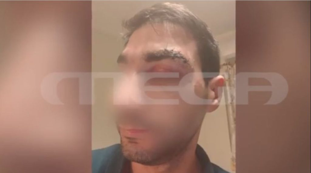 Σοκάρουν οι δηλώσεις του γιατρού από το Αίγιο: «Ο μποξέρ με πλάκωσε στο ξύλο – Δεν του άρεσε η μούρη μου» (βίντεο)