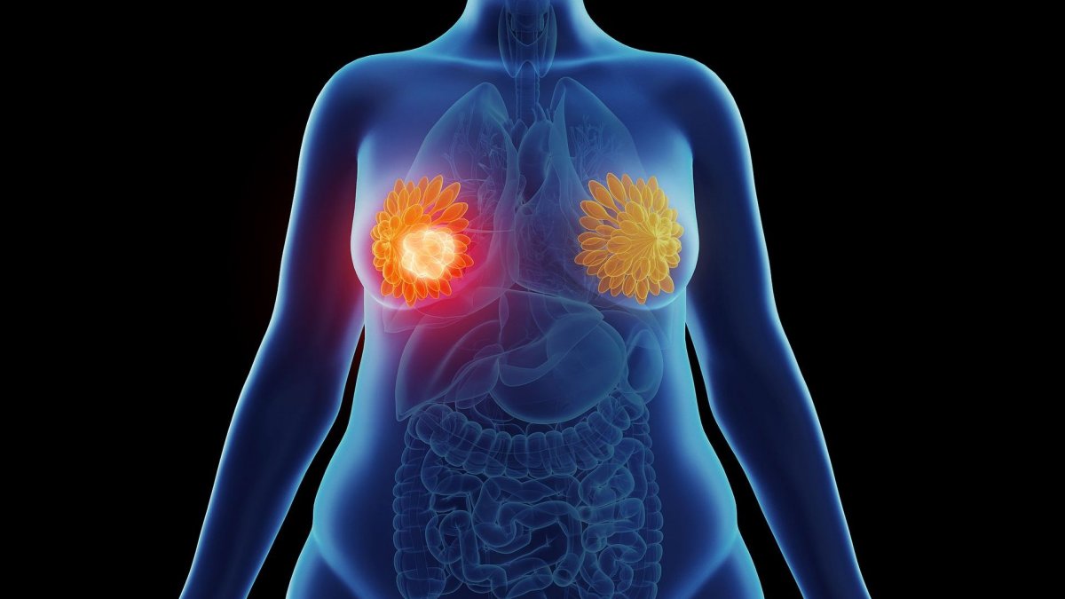 Σοκ για γυναίκα: Της έστειλαν λάθος διάγνωση ότι έχει καρκίνο στο μαστό – «Μου είπαν ότι είναι τυπογραφικό λάθος»