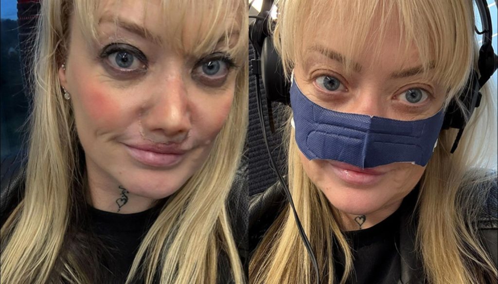 Εφιάλτης για Βρετανίδα που πήγε στην Τουρκία για νέα δόντια: «Μόλυνση μου “έφαγε” τη μύτη» (βίντεο)