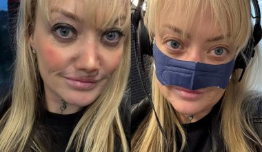 Εφιάλτης για Βρετανίδα που πήγε στην Τουρκία για νέα δόντια: «Μόλυνση μου “έφαγε” τη μύτη» (βίντεο)