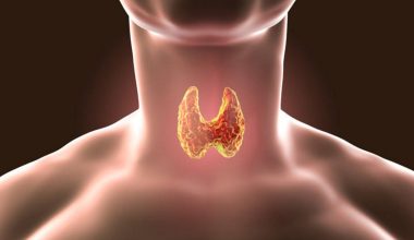 Βρογχοκήλη: Αυτά είναι τα ορατά και φυσικά σημάδια διόγκωσης του θυρεοειδούς