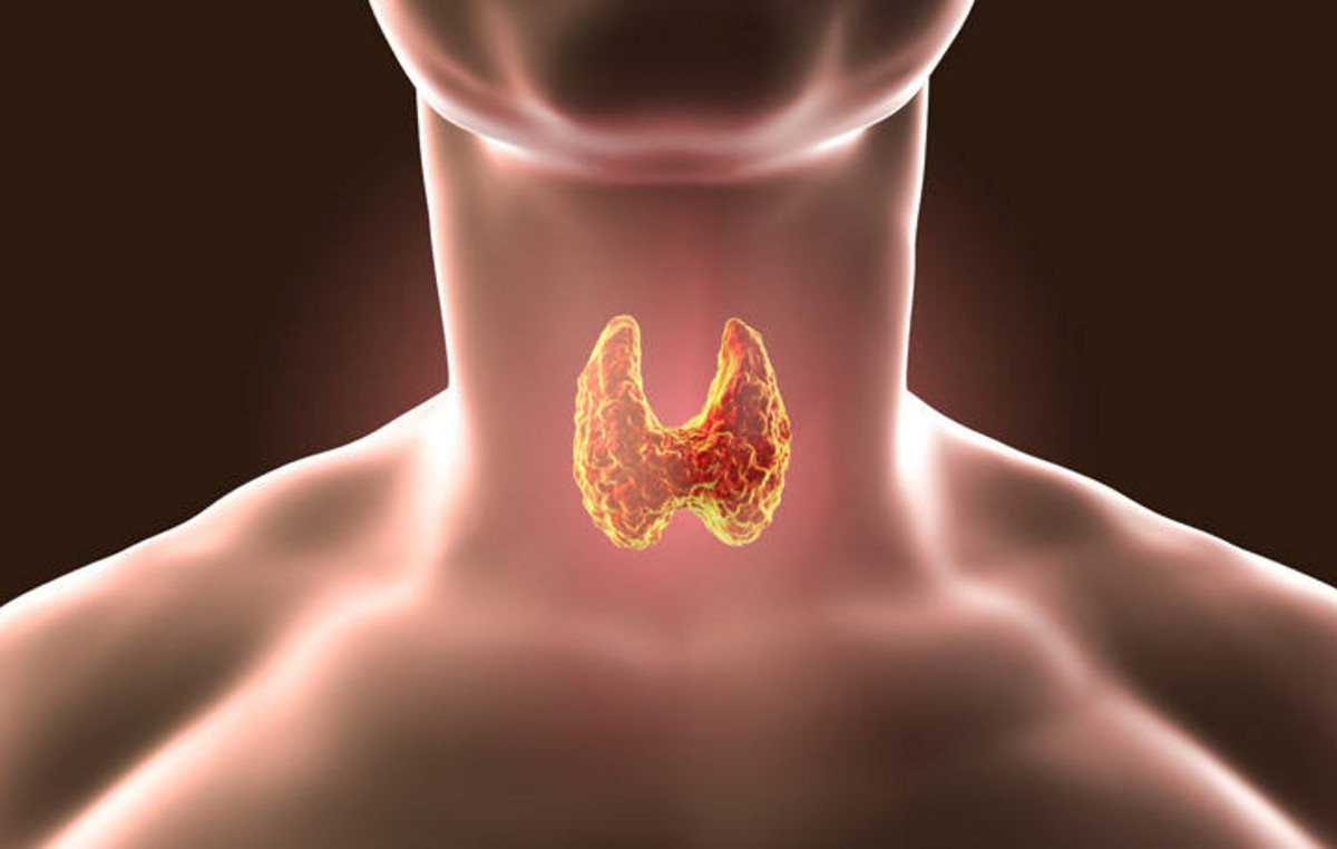 Βρογχοκήλη: Αυτά είναι τα ορατά και φυσικά σημάδια διόγκωσης του θυρεοειδούς