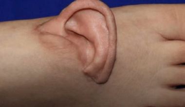 Η Κίνα θέτει νέα παγκόσμια χειρουργικά δεδομένα: Έσωσαν αυτί με μεταμόσχευση στο πόδι! (τρομακτική φωτό)