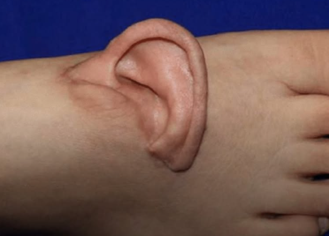 Η Κίνα θέτει νέα παγκόσμια χειρουργικά δεδομένα: Έσωσαν αυτί με μεταμόσχευση στο πόδι! (τρομακτική φωτό)