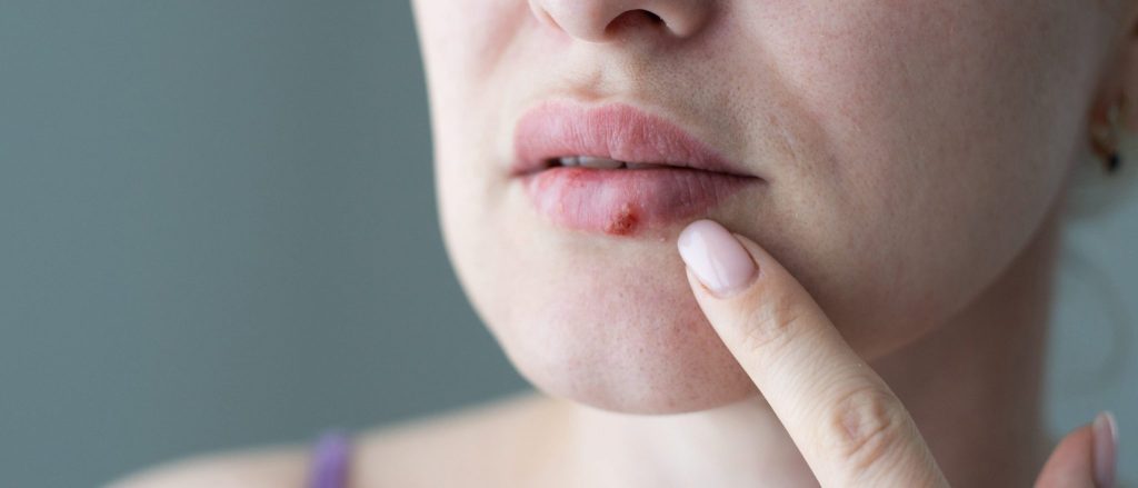 Επιχείλιος έρπης: Τα συμπτώματα και τι να κάνετε για να απαλλαγείτε από τις πληγές