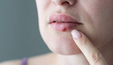 Επιχείλιος έρπης: Τα συμπτώματα και τι να κάνετε για να απαλλαγείτε από τις πληγές