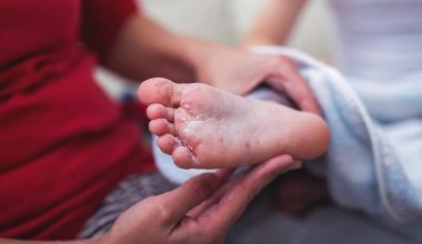 Ολοένα και αυξάνονται τα κρούσματα ιλαράς στις ΗΠΑ: Πάνω από 600 στη Νότια Καρολίνα