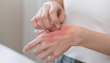 Έκζεμα: Δείτε πώς να αντιμετωπίσετε τις εξάρσεις που προκαλούνται από το κρύο