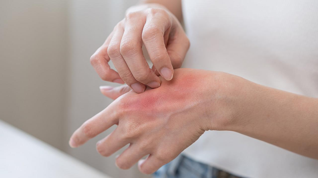 Έκζεμα: Δείτε πώς να αντιμετωπίσετε τις εξάρσεις που προκαλούνται από το κρύο