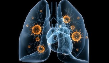 Τι είναι ο πνευμονιόκοκκος από τον οποίο προσβλήθηκε η Σ.Κοσιώνη