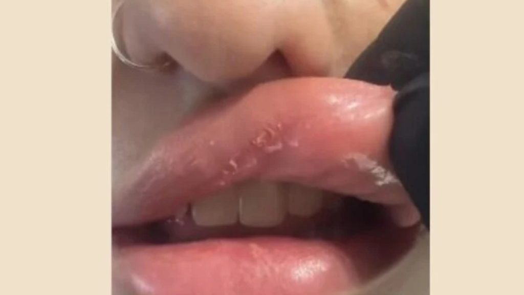 Πάτρα: Έβαλε υαλουρονικό σε νυχάδικο και παραμορφώθηκε – «Χρησιμοποιούν κινέζικα υλικά»