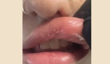 Πάτρα: Έβαλε υαλουρονικό σε νυχάδικο και παραμορφώθηκε – «Χρησιμοποιούν κινέζικα υλικά»