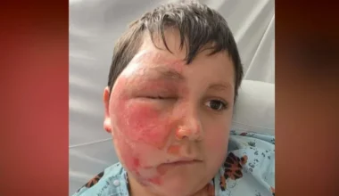 Το επικίνδυνο challenge του TikTok με φούρνο μικροκυμάτων: 9χρονος υπέστη σοβαρά εγκαύματα (βίντεο)