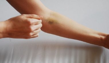 Δείτε γιατί μελανιάζετε εύκολα: Προειδοποιητικά σημάδια που απαγορεύεται να υποτιμήσετε