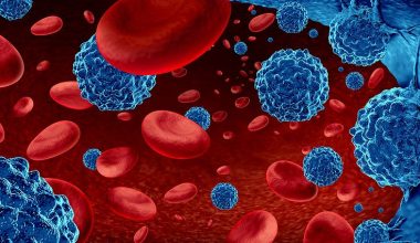 Λέμφωμα: Αυτά είναι τα προειδοποιητικά συμπτώματα που δεν πρέπει να αγνοήσετε