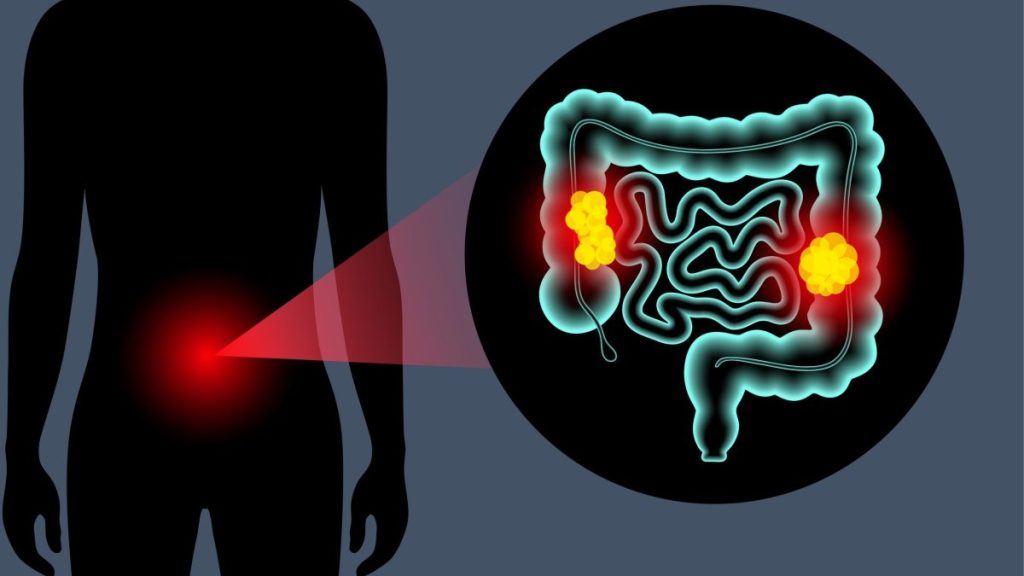 Καρκίνος παχέος εντέρου: Τα 4 βασικά συμπτώματα που μπορεί να εμφανιστούν έως και 2 χρόνια πριν από τη διάγνωση
