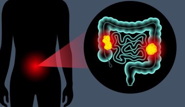Καρκίνος παχέος εντέρου: Τα 4 βασικά συμπτώματα που μπορεί να εμφανιστούν έως και 2 χρόνια πριν από τη διάγνωση