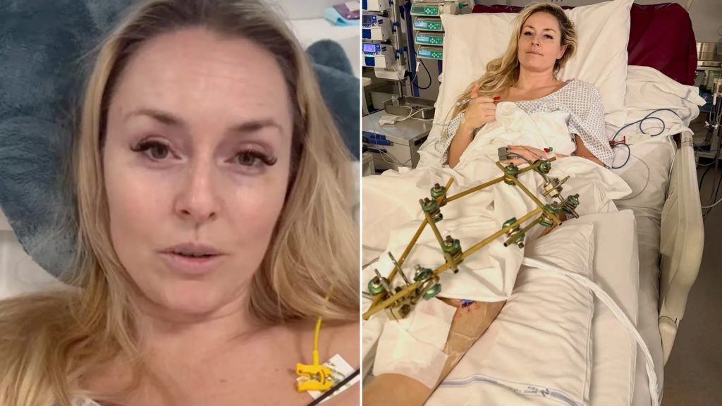 Λίντσεϊ Βον: «Έφτασα πολύ κοντά στον ακρωτηριασμό του ποδιού – Ο γιατρός με έσωσε κάνοντάς μου φασιοτομή» (βίντεο)