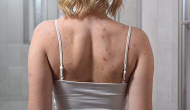 Όσα πρέπει να ξέρετε για την ακμή στην πλάτη: Από τι προκαλείται και ποιοι είναι οι κύριοι παράγοντες κινδύνου