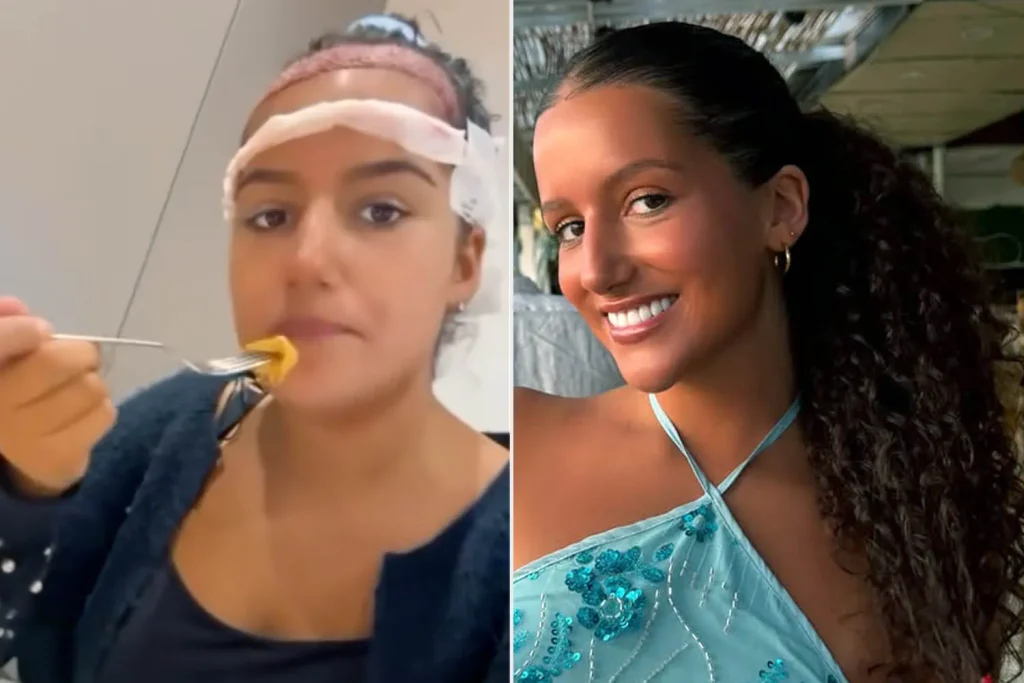 «Πήγε για μαλλί και…έγινε viral»: Έφτασε μέχρι την Τουρκία για μεταμόσχευση μαλλιών – Το τελικό αποτέλεσμα