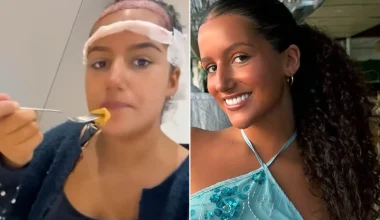 «Πήγε για μαλλί και…έγινε viral»: Έφτασε μέχρι την Τουρκία για μεταμόσχευση μαλλιών – Το τελικό αποτέλεσμα