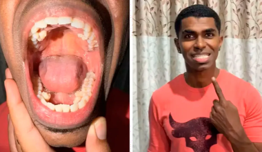 Ο άνδρας από τη Μαλαισία που έχει τα περισσότερα δόντια στον κόσμο: Πόσα είναι και τι πάθηση έχει (βίντεο)