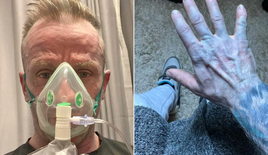Οι γιατροί ξέσπασαν σε γέλια: Ο απίστευτος λόγος που ένας άνδρας στη Βρετανία ξύπνησε… όλος μπλε! (φώτο)