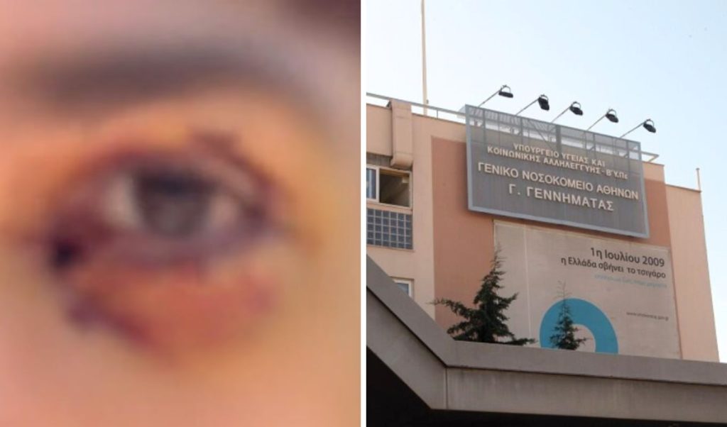 Ξυλοδαρμός 16χρονου στα Ιωάννινα: Μόνιμη βλάβη στο μάτι για τον ανήλικο που ξυλοκοπήθηκε άγρια από μια παρέα