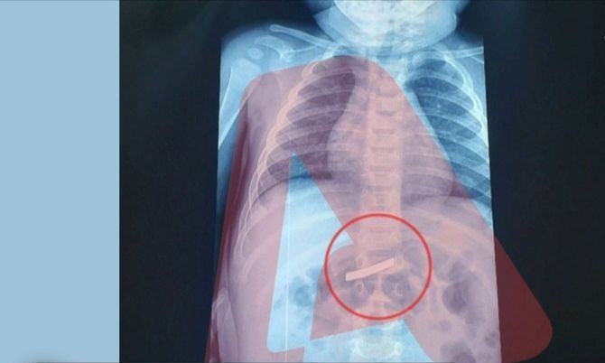 Απίστευτο: 3χρονο αγόρι κατάπιε ξυραφάκι – Υποβλήθηκε άμεσα σε χειρουργική επέμβαση