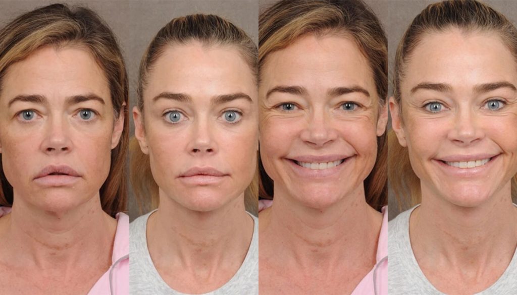 Η Ντενίζ Ρίτσαρντς «τραβήχτηκε»: Οι φωτογραφίες από το πριν και το μετά το λίφτινγκ που δημοσίευσε ο πλαστικός της