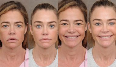 Η Ντενίζ Ρίτσαρντς «τραβήχτηκε»: Οι φωτογραφίες από το πριν και το μετά το λίφτινγκ που δημοσίευσε ο πλαστικός της