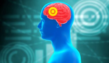 Τι είναι το εγκεφαλικό ανεύρυσμα με το οποίο διαγνώστηκε ο Γ.Μυλωνάκης; – Τα συμπτώματα