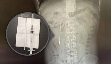 Έβγαλαν θερμόμετρο από Κινέζο που είχε καταπιεί πριν από 32 χρόνια!