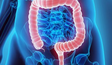 Τι είναι ο αποφρακτικός ειλεός με τον οποίο διαγνώστηκε η Μαρέβα Γκραμπόφσκι-Μητσοτάκη;