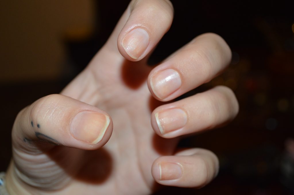 Δείτε πώς να ελέγξετε τα νύχια σας για σημάδια μελανώματος: Ποια τα συμπτώματα