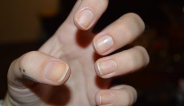 Δείτε πώς να ελέγξετε τα νύχια σας για σημάδια μελανώματος: Ποια τα συμπτώματα