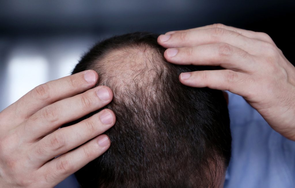 Η Κίνα «φέρνει» το τέλος της… καράφλας: Νέος φυτικός ορός επαναφέρει τα μαλλιά μέσα σε λίγες εβδομάδες!