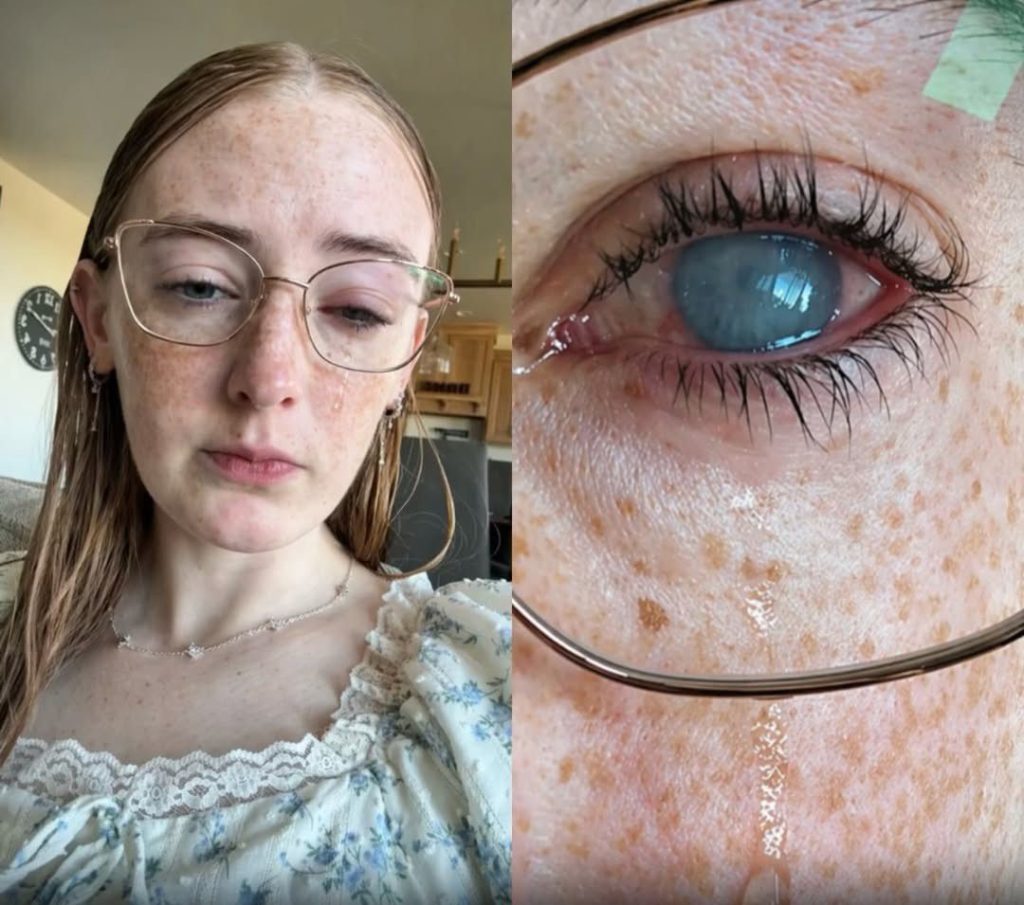 Βίντεο: Έχασε το μάτι της γιατί έκανε ντους με φακούς επαφής στον Άγιο Δομίνικο!