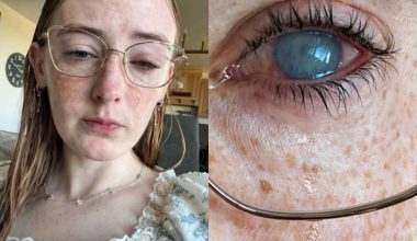 Βίντεο: Έχασε το μάτι της γιατί έκανε ντους με φακούς επαφής στον Άγιο Δομίνικο!