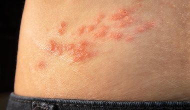 Έρπης ζωστήρας: Δείτε ποιοι κινδυνεύουν περισσότερο και πώς εκδηλώνεται