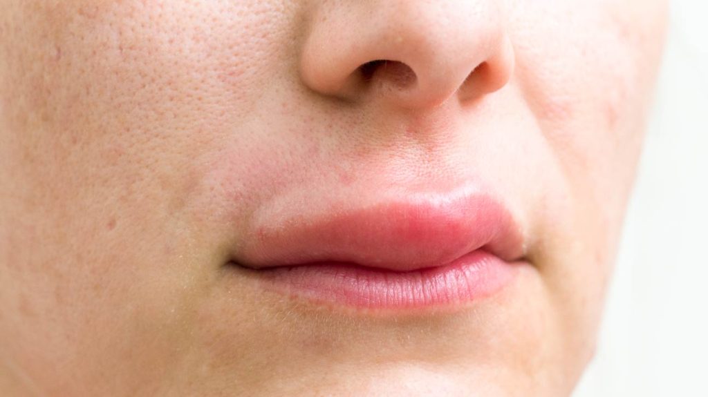 Δείτε γιατί κάποιες φορές ξυπνάτε με πρησμένα χείλη – Όλες οι πιθανές αιτίες