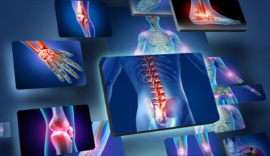 Ιάπωνες επιστήμονες ανέπτυξαν χάπι που αναδομεί τα οστά και μπορεί να αναστρέψει την οστεοπόρωση