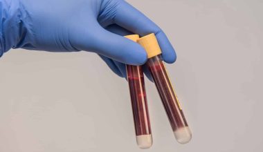 Τεστ αίματος μπορεί να ανιχνεύσει πρώιμες βλάβες στο ήπαρ πριν εξελιχθούν σε καρκίνο