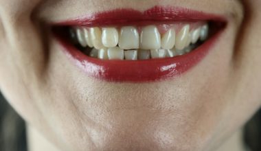 Εφιάλτης για Βρετανίδα στην Τουρκία: Πήγε για να φτιάξει τα δόντια της και έμεινε… φαφούτα – Δεν μπορεί να φάει