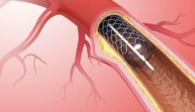 Επιστήμονες ανέπτυξαν stent που κρατά ανοιχτές τις αρτηρίες και στη συνέχεια απορροφάται από τον οργανισμό