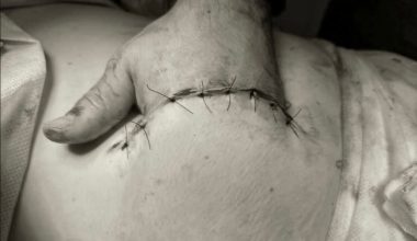 Ρωσία: «Έραψαν» το χέρι εργάτη μέσα στην κοιλιά του για να το σώσουν από ακρωτηριασμό!