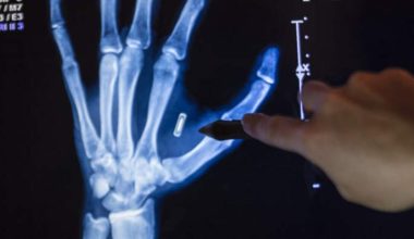 Σουηδία: Χιλιάδες πολίτες εμφυτεύουν μικροτσίπ στα χέρια τους για να μην μεταφέρουν κλειδιά και κάρτες!