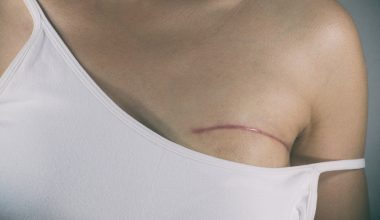 Γυναίκα στη Θεσσαλονίκη υποβλήθηκε σε μαστεκτομή ενώ δεν είχε καρκίνο & πήρε αποζημίωση: «Έγινε ένα αδιανόητο λάθος»