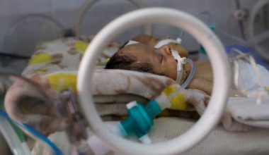 Σαουδική Αραβία: Σιαμαία κοριτσάκια από τις Φιλιππίνες διαχωρίστηκαν επιτυχώς μετά από επέμβαση έξι ωρών
