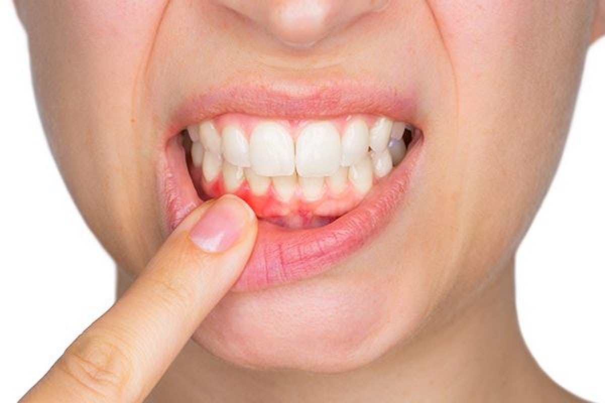 Νέα μελέτη συνδέει βακτήριο της περιοδοντίτιδας με πιθανή βλάβη στην αορτική βαλβίδα της καρδιάς!